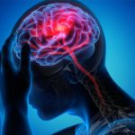 تحریک نخاع به بازیابی قدرت بازو پس از سکته مغزی کمک می کند